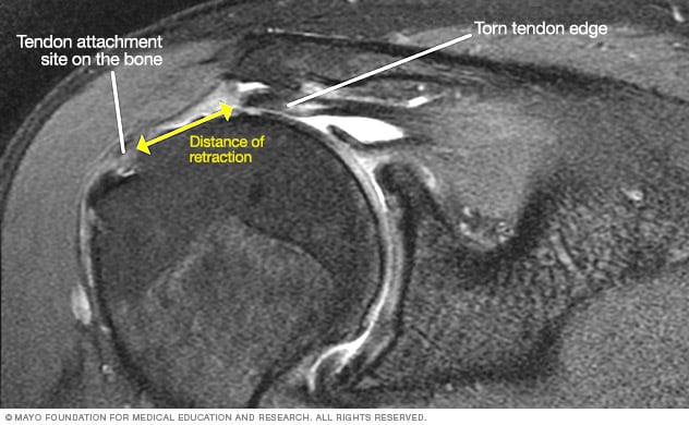 diagnosis rotator cuff injury mayo clinic rotator cuff tear mri